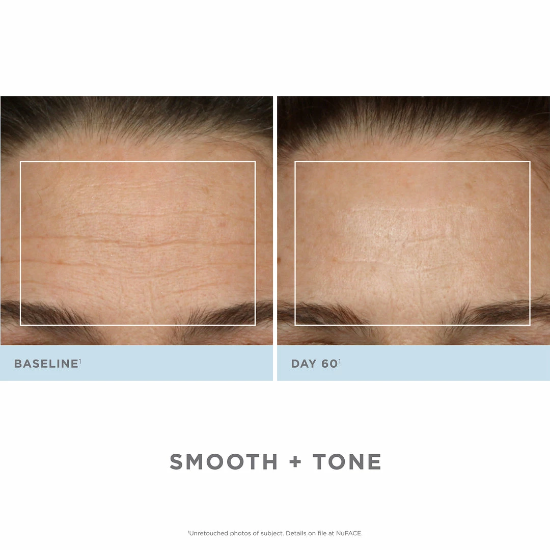 NuFACE Trinity Pro Facial Toning Kit + Wrinkle Reducer 9 NuFACE Trinity Pro Facial Toning Kit + Wrinkle Reducer