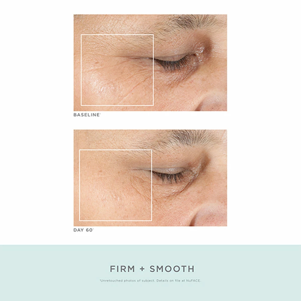 NuFACE Trinity Effective Lip & Eye Attachment 4 NuFACE Trinity Effective Lip & Eye Attachment