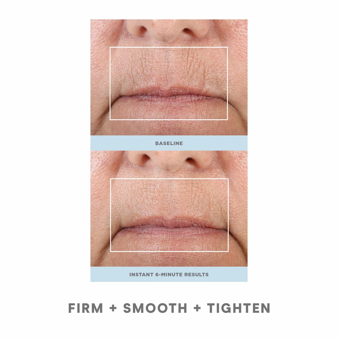 NuFACE FIX 4 NuFACE FIX